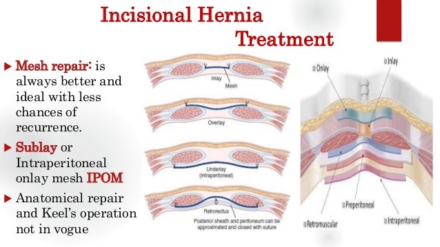 Oslo norway girls Open ventral hernia repair technique